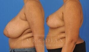 tjelmeland-meridian-austin-breast-reduction-patient-4-2