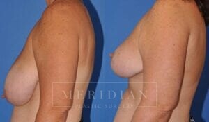 tjelmeland-meridian-austin-breast-reduction-patient-5-2