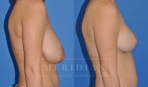 tjelmeland-meridian-austin-breast-reduction-patient-6-2