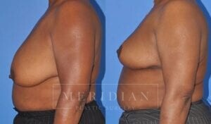 tjelmeland-meridian-austin-breast-reduction-patient-7-2