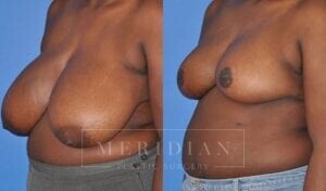 tjelmeland-meridian-austin-breast-reduction-patient-8-2