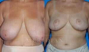 tjelmeland-meridian-austin-breast-reduction-patient-9-1