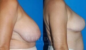 tjelmeland-meridian-austin-breast-reduction-patient-9-2