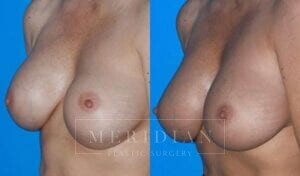 tjelmeland-meridian-austin-breast-revision-patient-1-2