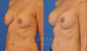 tjelmeland-meridian-austin-breast-revision-patient-10-2