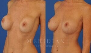 tjelmeland-meridian-austin-breast-revision-patient-2-2