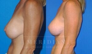 tjelmeland-meridian-austin-breast-revision-patient-4-2