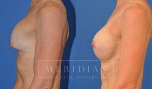 tjelmeland-meridian-austin-breast-revision-patient-5-2