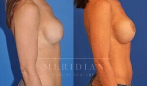 tjelmeland-meridian-austin-breast-revision-patient-7-2