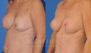 tjelmeland-meridian-austin-breast-revision-patient-9-2