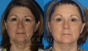 tjelmeland-meridian-austin-brow-lift-patient-1-1