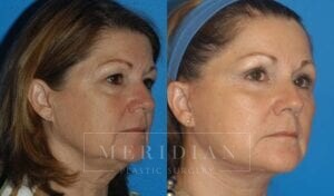 tjelmeland-meridian-austin-brow-lift-patient-1-2