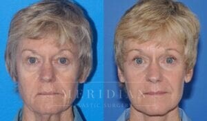 tjelmeland-meridian-austin-brow-lift-patient-2-1