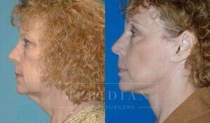 tjelmeland-meridian-austin-brow-lift-patient-3-2