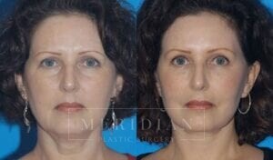 tjelmeland-meridian-austin-brow-lift-patient-4-1