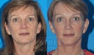 tjelmeland-meridian-austin-brow-lift-patient-5-1