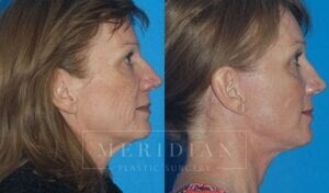 tjelmeland-meridian-austin-brow-lift-patient-5-2