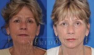 tjelmeland-meridian-austin-brow-lift-patient-6-1