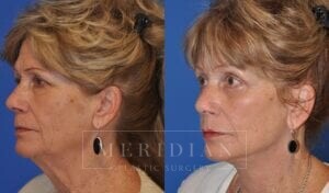 tjelmeland-meridian-austin-brow-lift-patient-6-2