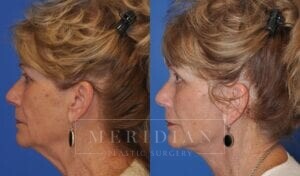 tjelmeland-meridian-austin-brow-lift-patient-6-3