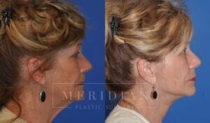 tjelmeland-meridian-austin-brow-lift-patient-6-4