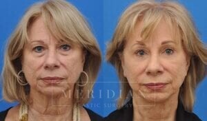 tjelmeland-meridian-austin-brow-lift-patient-7-1