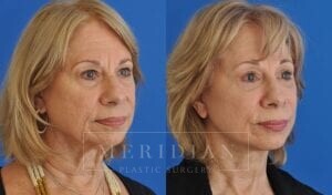 tjelmeland-meridian-austin-brow-lift-patient-7-2