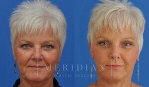 tjelmeland-meridian-austin-brow-lift-patient-8-1