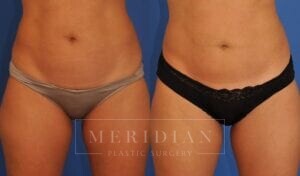 tjelmeland-meridian-austin-coolsculpting-patient-1-1