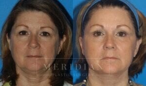 tjelmeland-meridian-austin-eyelid-lift-patient-1-1