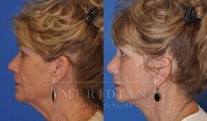 tjelmeland-meridian-austin-eyelid-lift-patient-6-3