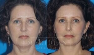 tjelmeland-meridian-austin-facelift-patient-1-1