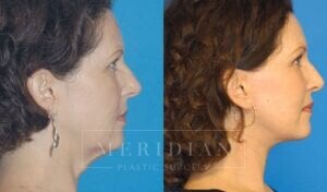 tjelmeland-meridian-austin-facelift-patient-1-2