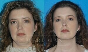 tjelmeland-meridian-austin-facelift-patient-10-1