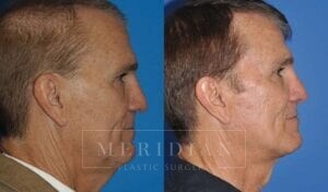 tjelmeland-meridian-austin-facelift-patient-11-2