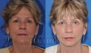 tjelmeland-meridian-austin-facelift-patient-12-2