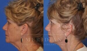 tjelmeland-meridian-austin-facelift-patient-12-3