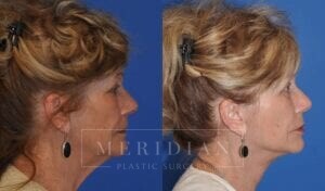 tjelmeland-meridian-austin-facelift-patient-12-4