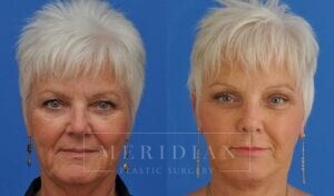 tjelmeland-meridian-austin-facelift-patient-14-1