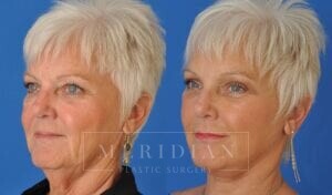 tjelmeland-meridian-austin-facelift-patient-14-2