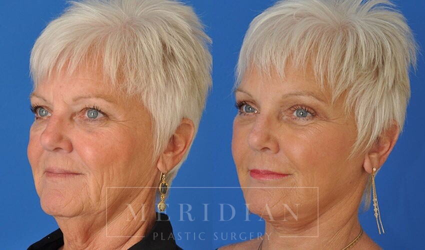 tjelmeland-meridian-austin-facelift-patient-14-2