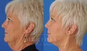 tjelmeland-meridian-austin-facelift-patient-14-3