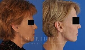 tjelmeland-meridian-austin-facelift-patient-15-3