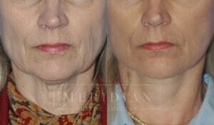 tjelmeland-meridian-austin-facelift-patient-2-1