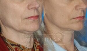 tjelmeland-meridian-austin-facelift-patient-2-2