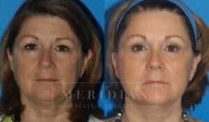 tjelmeland-meridian-austin-facelift-patient-3-1