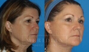 tjelmeland-meridian-austin-facelift-patient-3-2