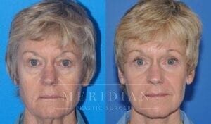 tjelmeland-meridian-austin-facelift-patient-4-1