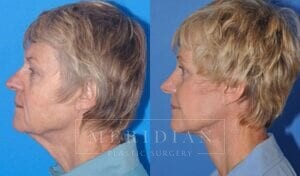 tjelmeland-meridian-austin-facelift-patient-4-2