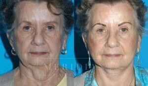 tjelmeland-meridian-austin-facelift-patient-5-1